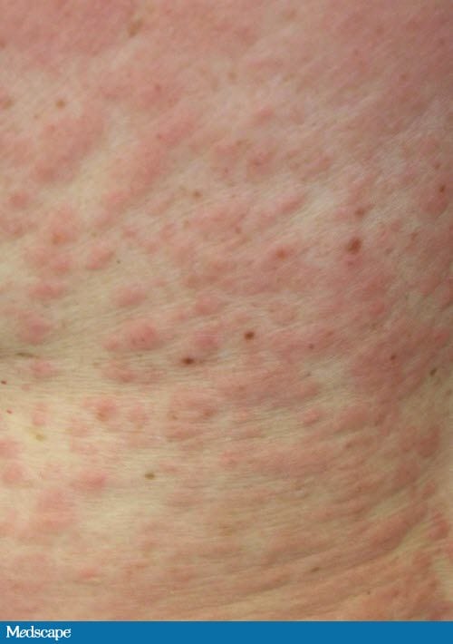 hepatitis rash #10