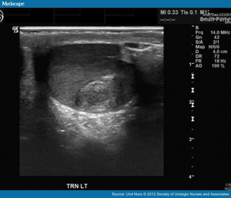 Ultrasound Of Testicles