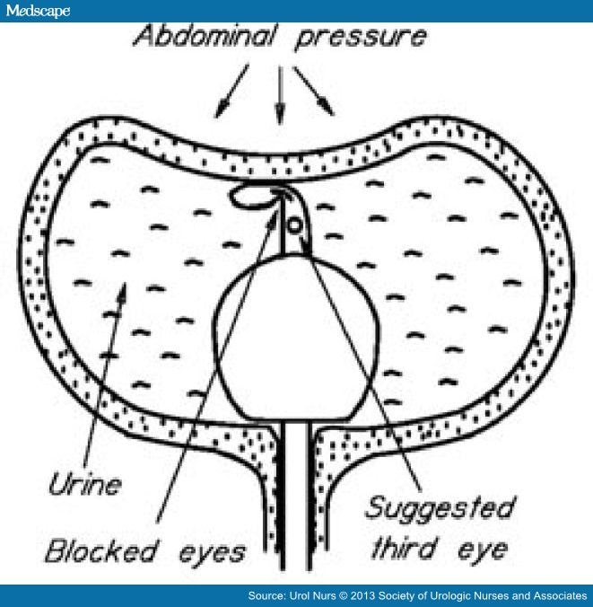 Catheter Leaking Male at David Collado blog