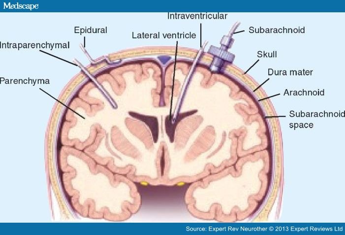 first signs and symptoms of a stroke