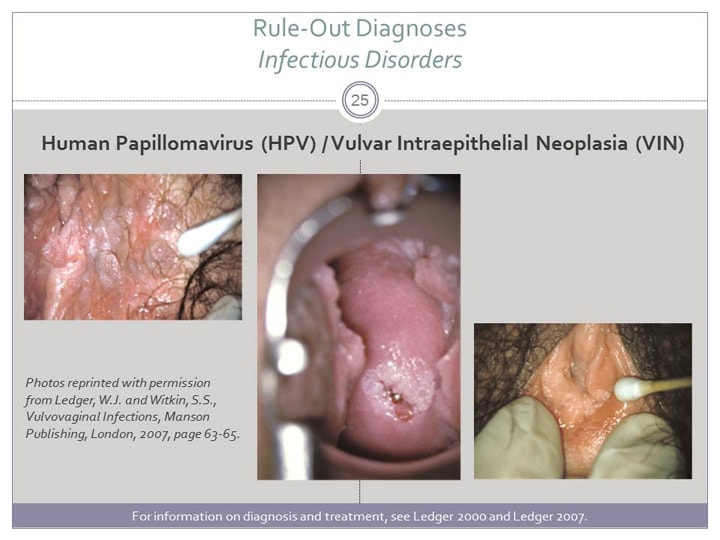 Eczema herpeticum – PubMed Central (PMC)