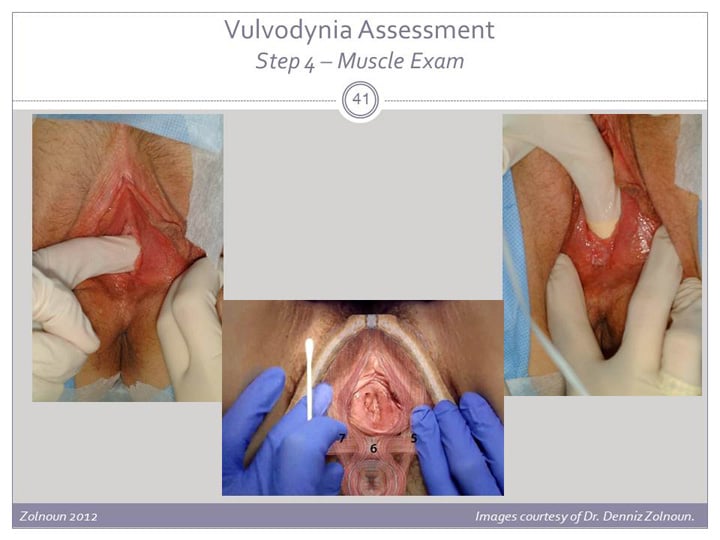 What is Vulvodynia?