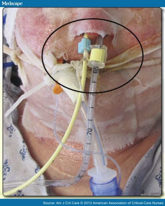 Nasal Bridling to Secure Enteral Tubes in Burn Patients