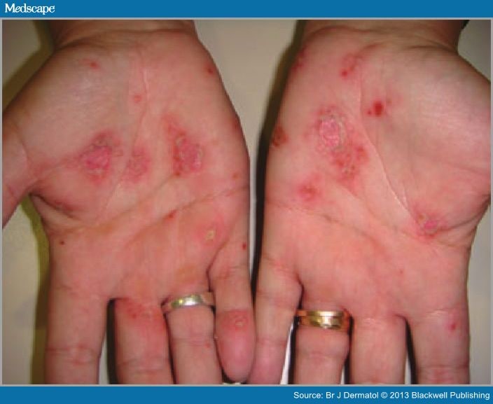 Dermatitis - Wikipedia