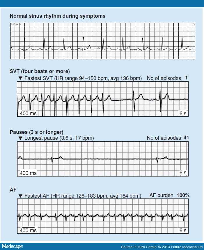 Printable Ekg Strips That Are Old Fashioned Harper Blog