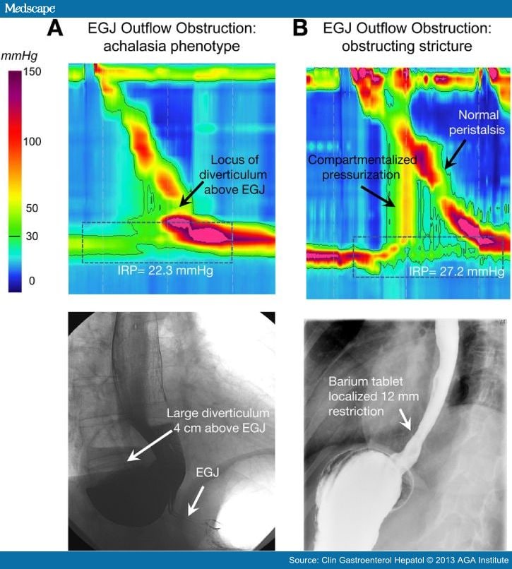 presentation-diagnosis-and-management-of-achalasia