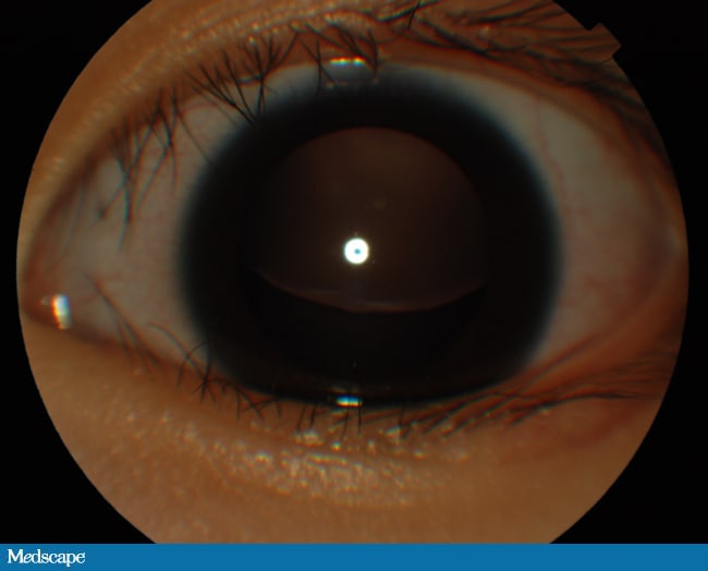 Lens Subluxation; Lens Dislocation
