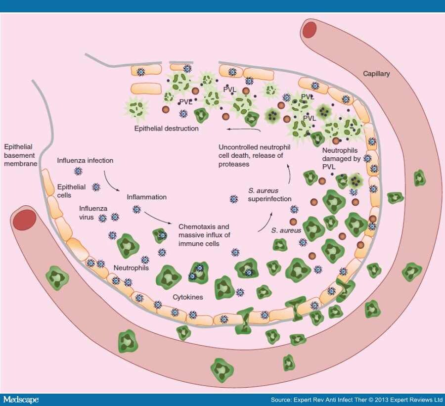 Pathogenesis Of Staphylococcus Aureus Necrotizing Pneumonia 7469