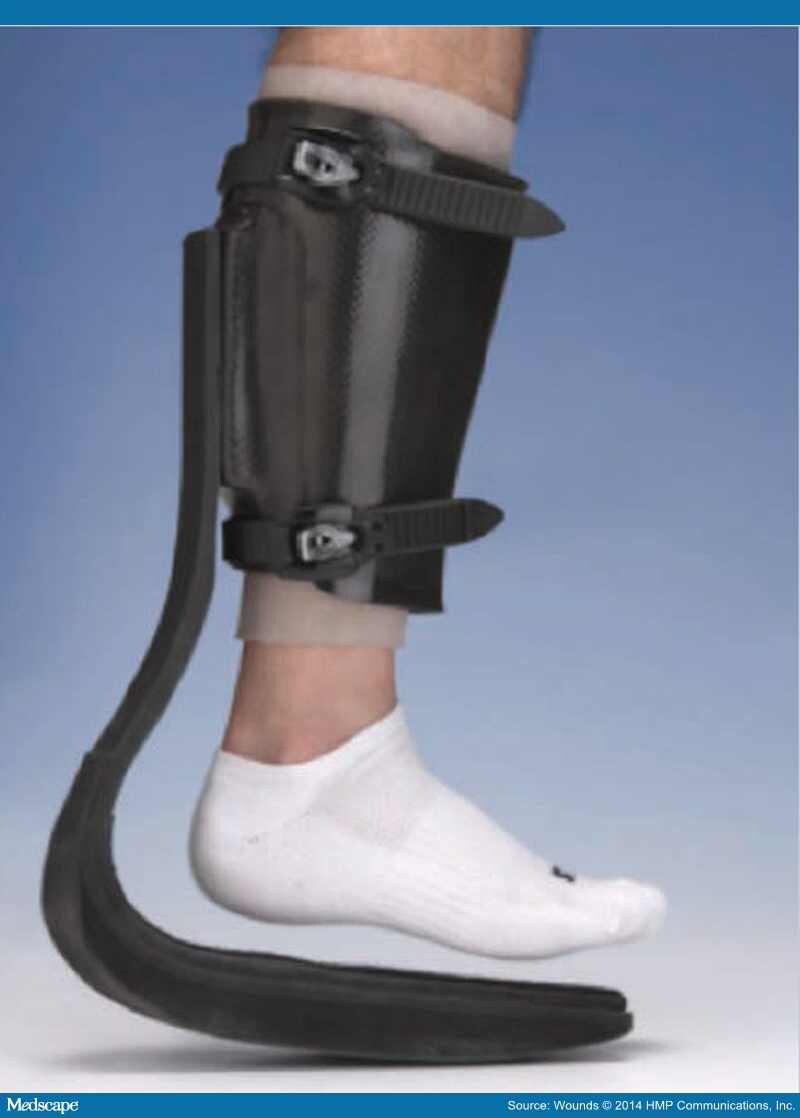 Offloading Foot Wounds in People With Diabetes