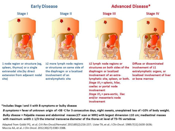Challenging Cases in Hodgkin Lymphoma