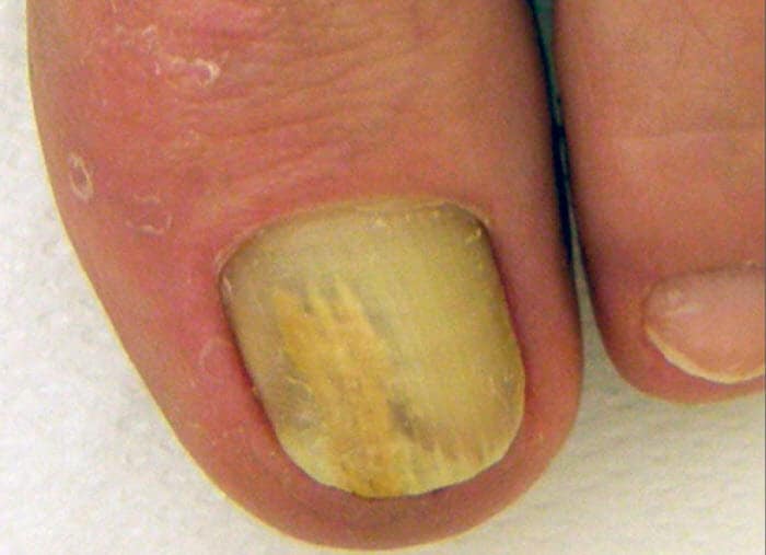 Onycholysis semilunaris (gedeeltelijke loslating nagel)