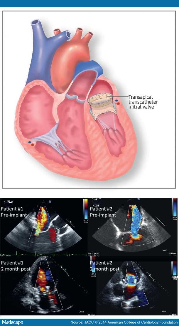 Transapical Transcatheter Mitral Valve Implantation