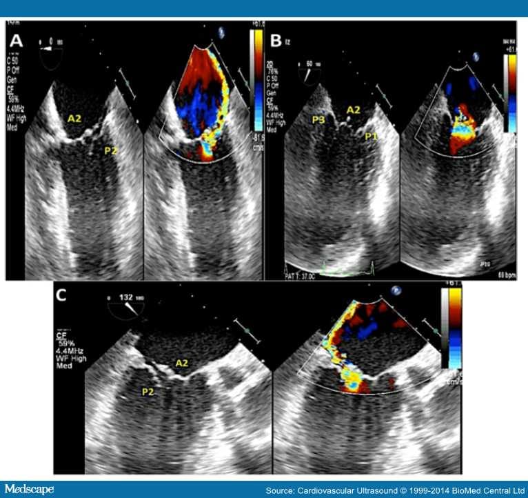 Pre-Op Assessment of Mitral Valve Regurgitation