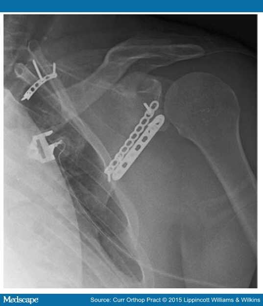 Scapular Fractures Diagnosis and Treatment Plan