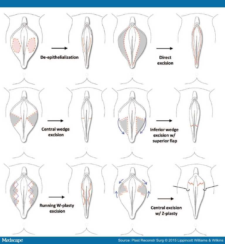 Vaginal Labiaplasty