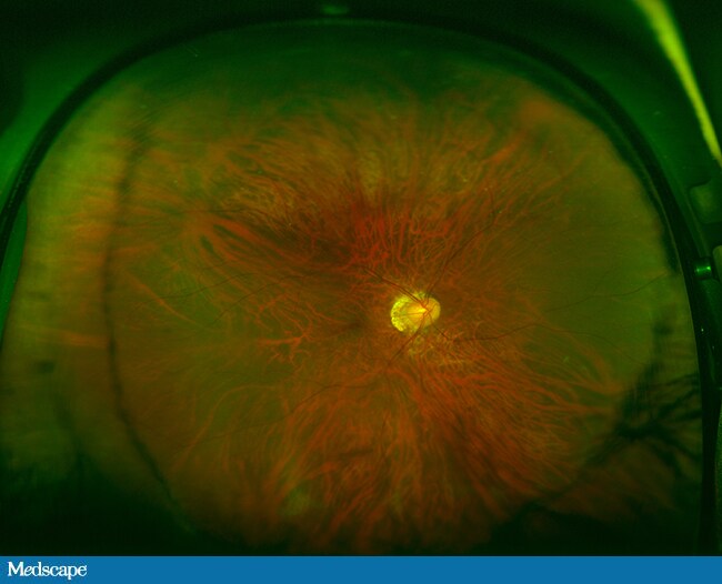 Bungee Cord Trauma to the Eye