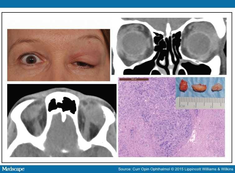 The Many Facets Of Dacryoadenitis