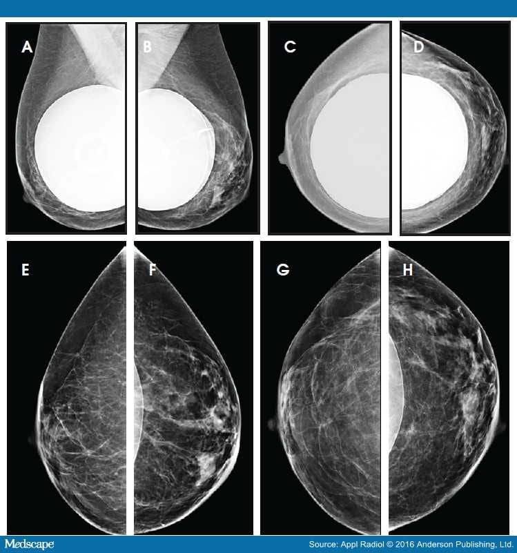 Cosmetic Breast Augmentation Mammographic Findings