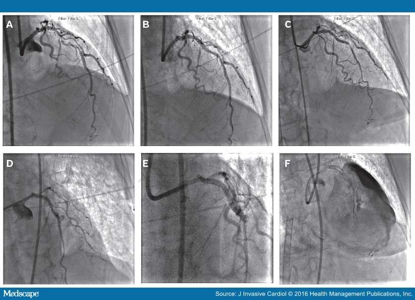 Coronary Artery Perforation Following PCI