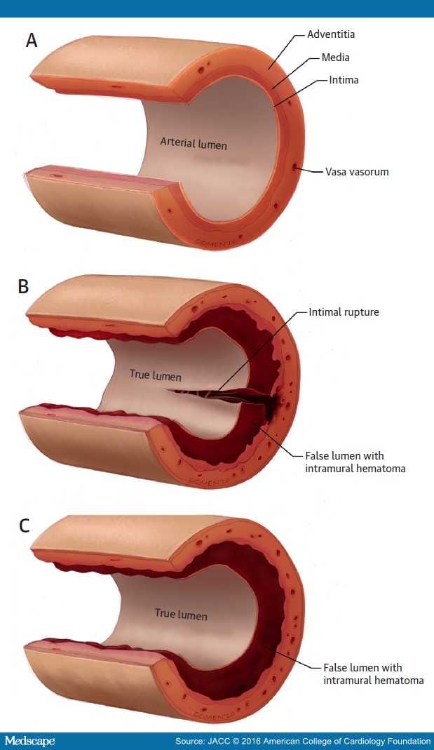 contemporary-review-on-spontaneous-coronary-artery-dissection