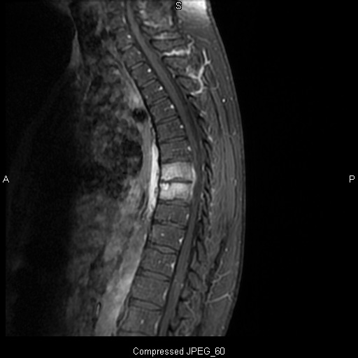 discitis on mri