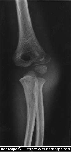 Condyle Fracture