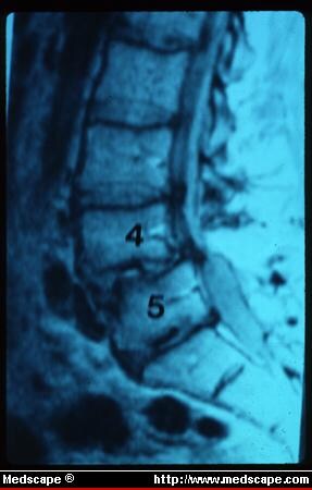 45+ Ligamentum Flavum Hypertrophy Mri Gif