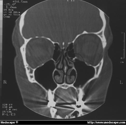 Thesis on functional endoscopic sinus surgery fess