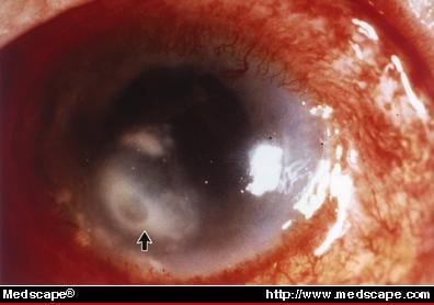 Corneal Ulcer Eye Patch