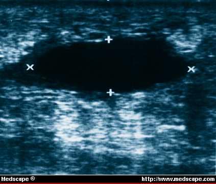 mammogram images of breast cancer. In this ultrasound follow-up