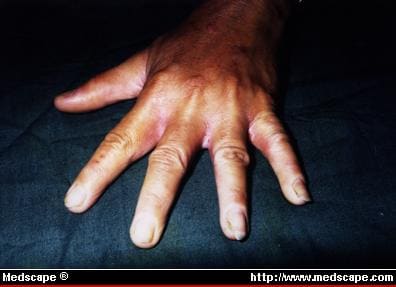 hand dermatoses #10