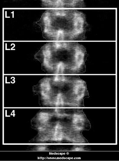 osteoporosis x ray. Using dual energy x-ray