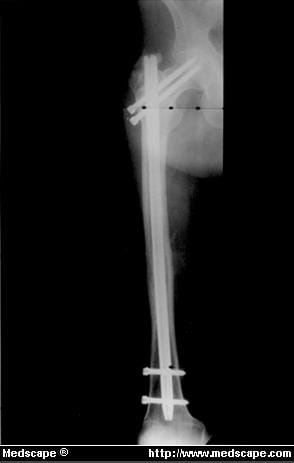 Ap Femur