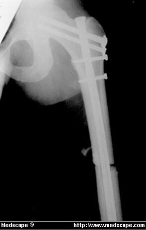 proximal femoral nailing thesis proximal femoral nailing thesis