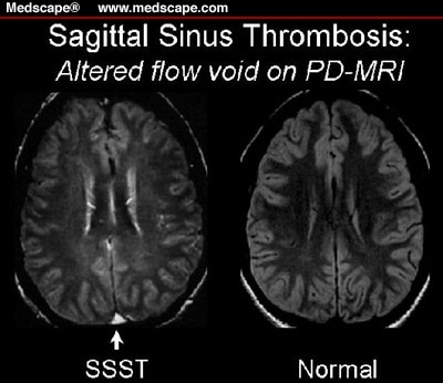 Another patient with superior sagittal sinus thrombosis (SSST) compared with 