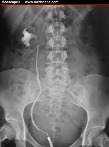 retrograde urethrogram radiology