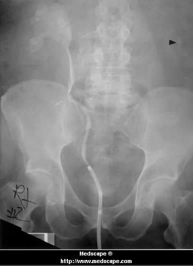 Retrograde Pyelogram