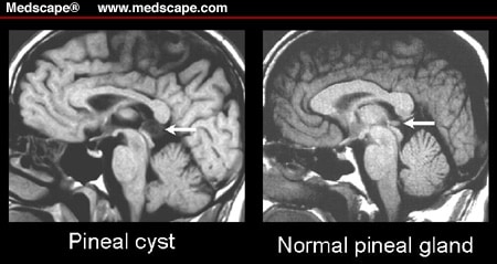 Calcified Pineal Cyst