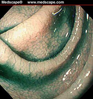 Mosaic Pattern Duodenum | a mosaic pattern of the descending duodenum Mosaic Pattern Duodenum | a mosaic pattern of the descending duodenum