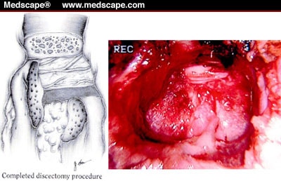 Discectomy Recovery