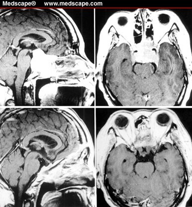 Surgical Approaches And Strategies For Skull Base Chordomas