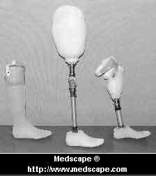 Prosthetic Leg Socket