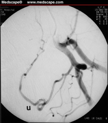 Treatment of Symptomatic Uterine Fibroids: UAE Technique 