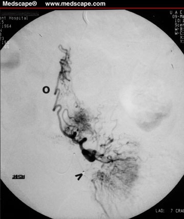 Treatment of Symptomatic Uterine Fibroids: Complications 