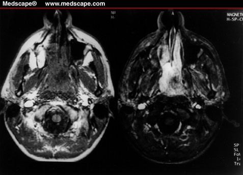 Nasal Mass