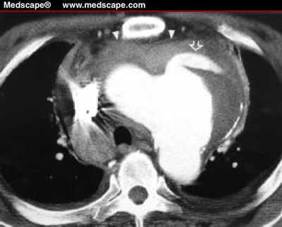 Aortic aneurysm rupture. Axial postcontrast image (window = 440, 
