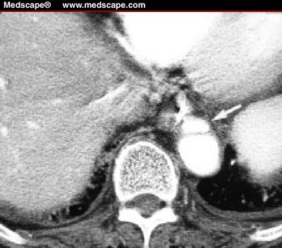 Helical CT Evaluation of the Thoracic Aorta: Aortic Pathology ... Helical CT Evaluation of the Thoracic Aorta: Aortic Pathology ...