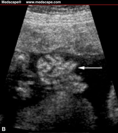 Gastroschisis Ultrasound
