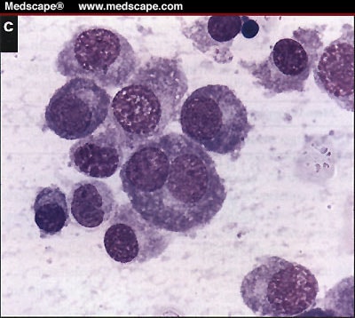 plasmablastic myeloma