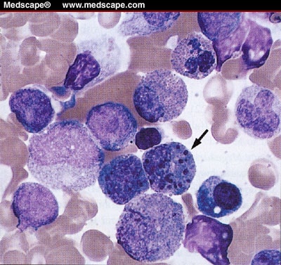 Acute Biphenotypic Leukemia